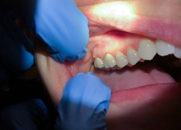 Best Emergency Dental Care for Broken or Chipped Teeth in Goshen, CA
